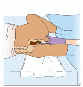 Digital examination. A fi nger is inserted into the person’s rectum to check for a fecal impaction.